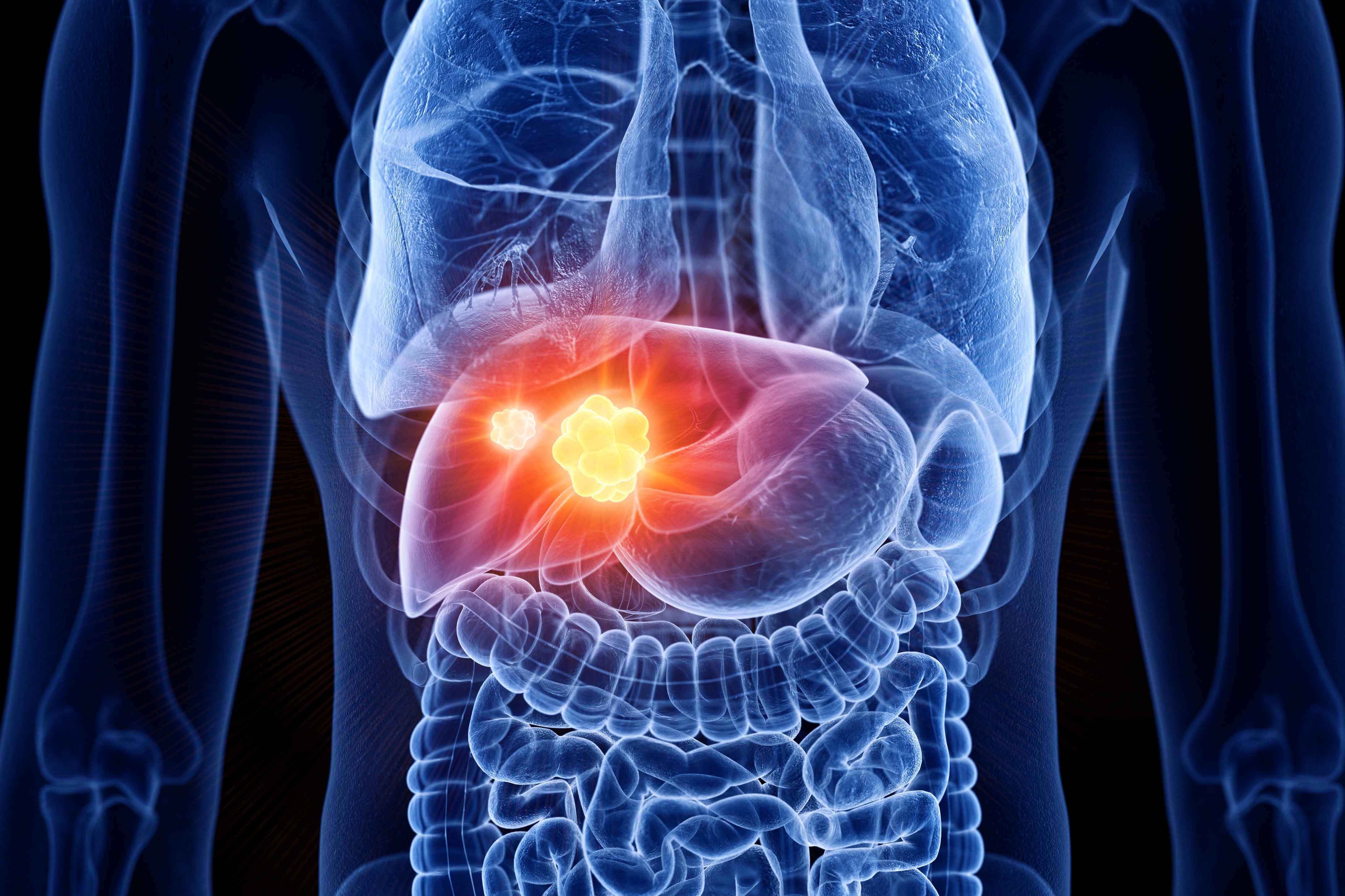 liver cancer symptoms