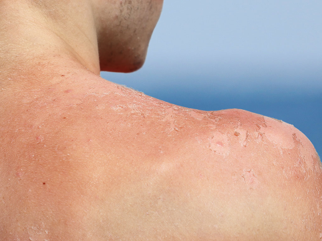 Sunburn: Symptoms & Treatment