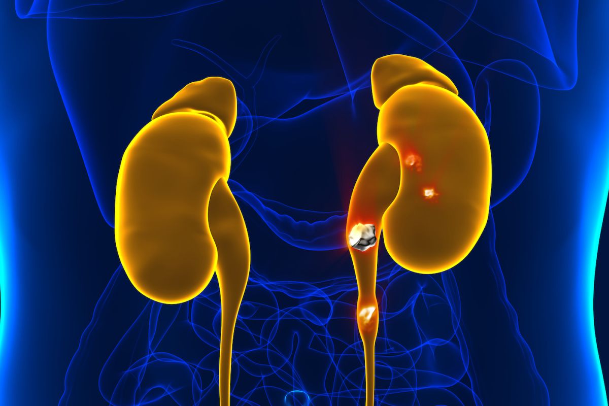 Graphic showing kidney stones forming in the kidney