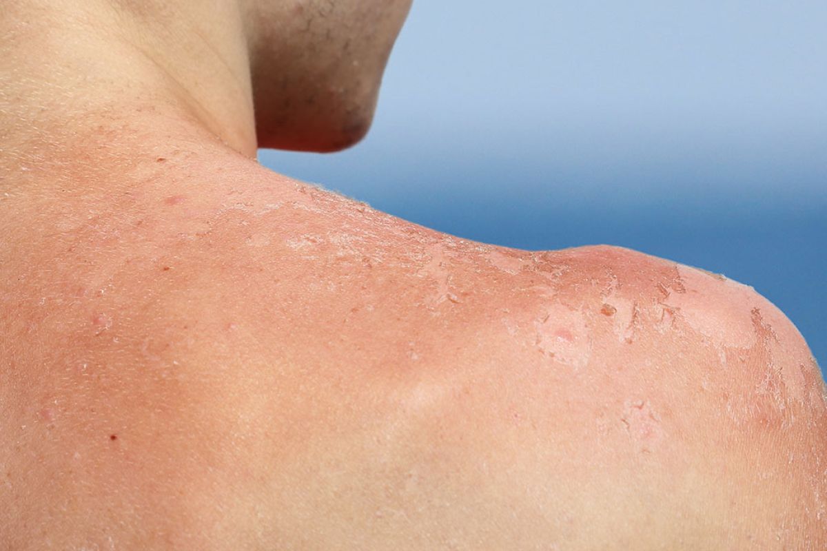 sunburned shoulder