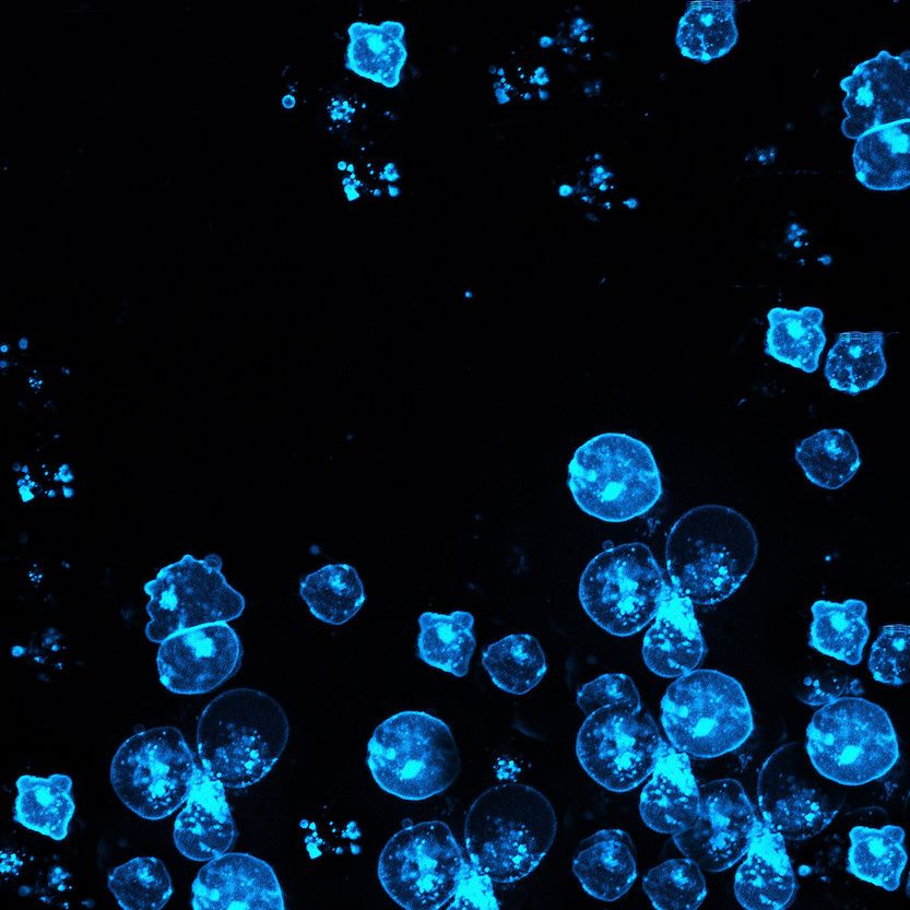 Leukemia cells fluorescing blue over a black backgrounnd