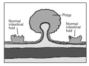 hpv and colon polyps)