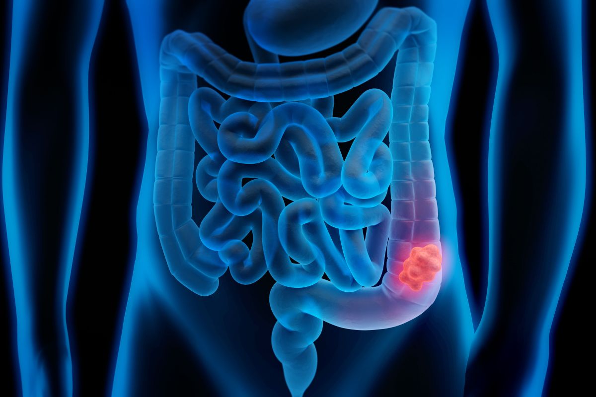 Colon cancer tumor 