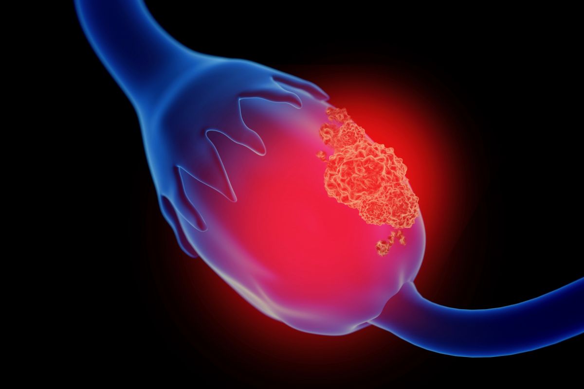 Illustration of an ovarian cancer tumor