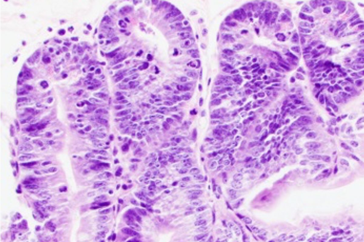 Small intestine cells showing signs of GVHD