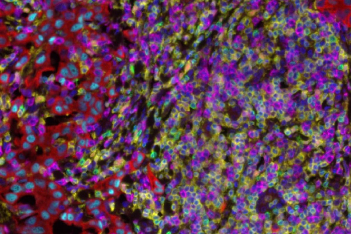Image showing a breast tumor with infiltrating immune cells. 