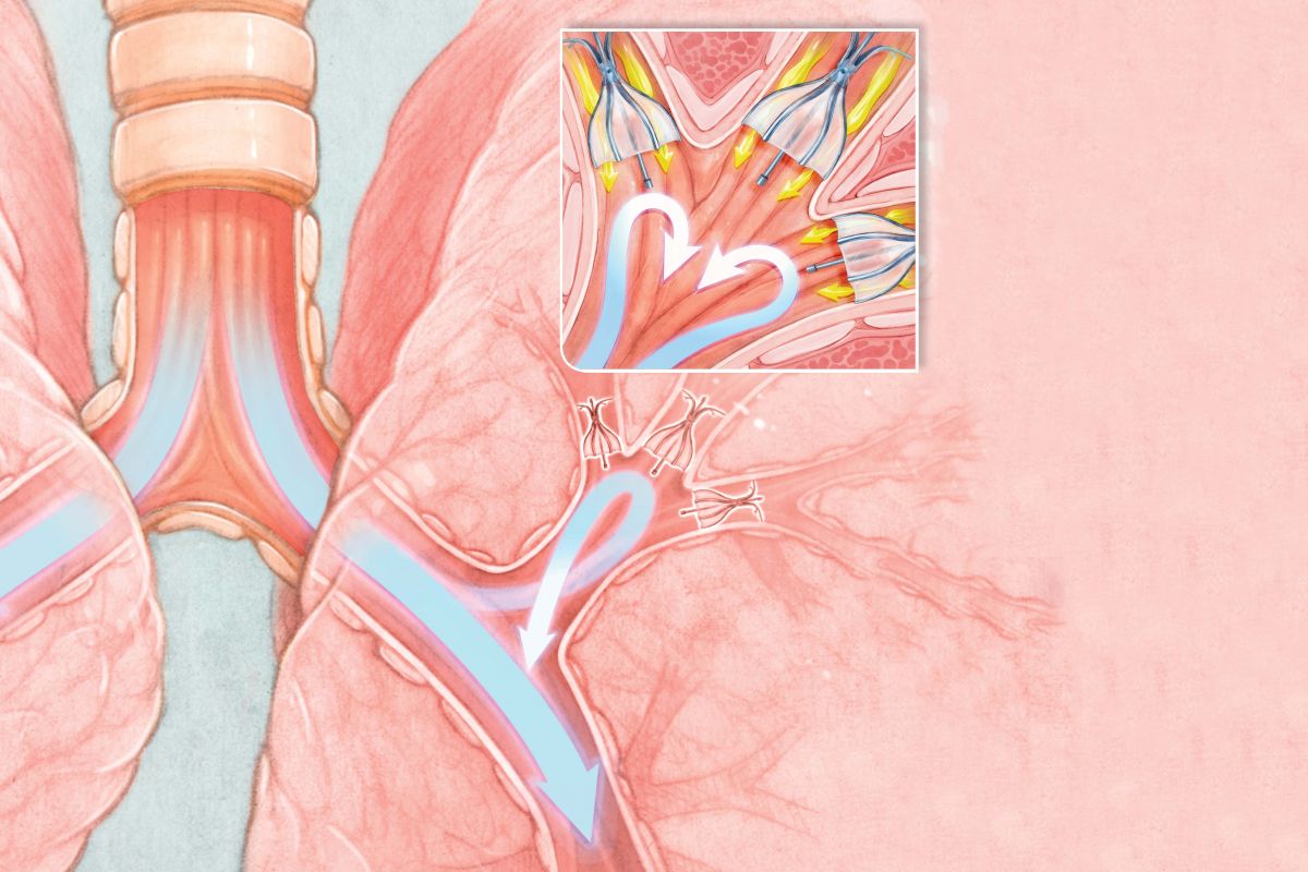 graphic of Olympus spiration valve system airway