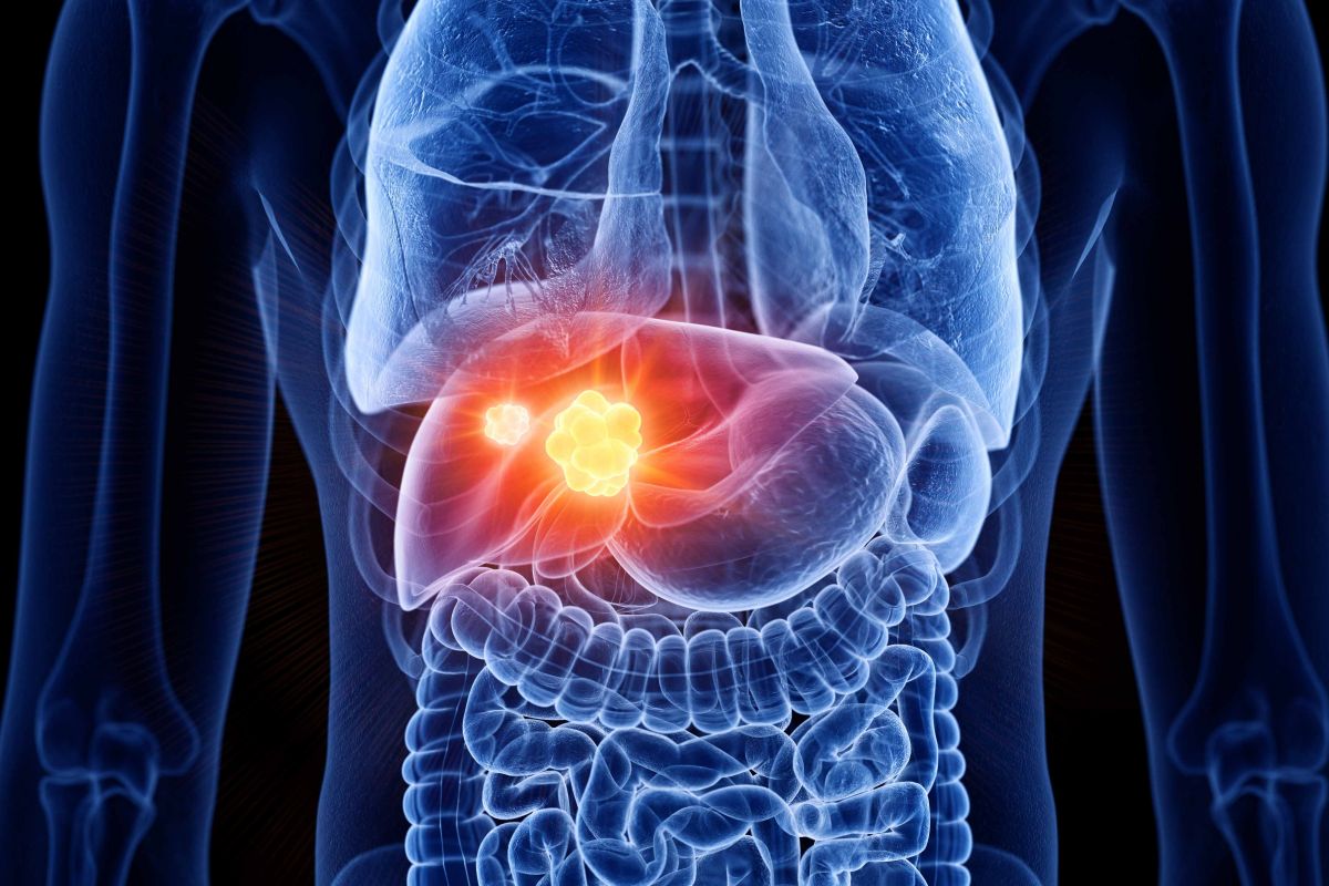 Liver Cancer Tumor