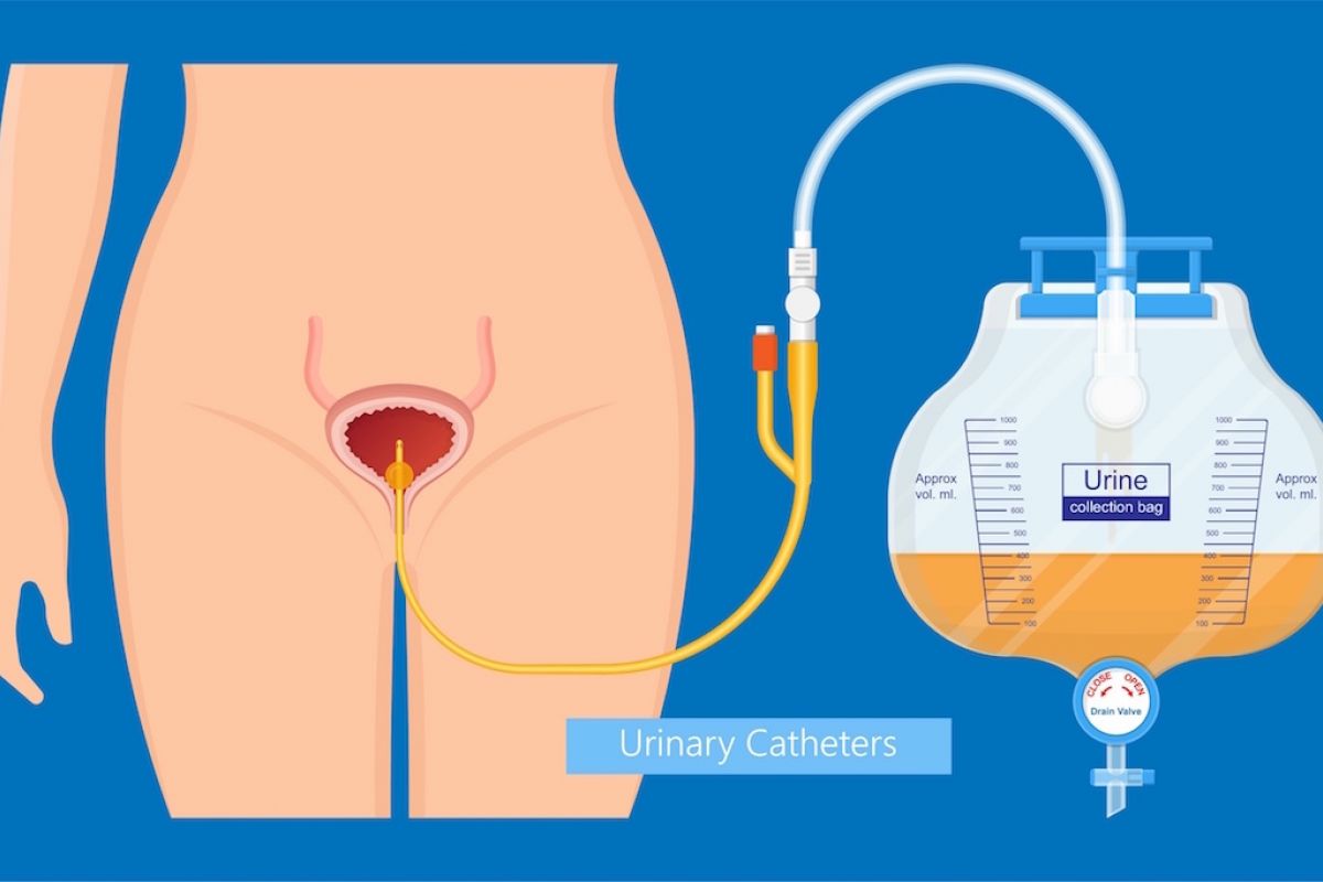 Illustration shows Foley catheter and how it connects to the bladder