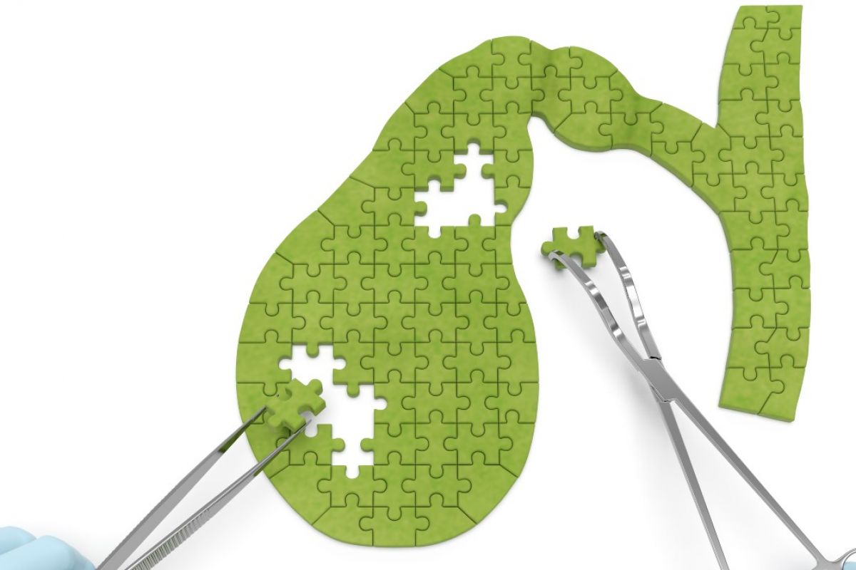 Gallbladder puzzle pieces