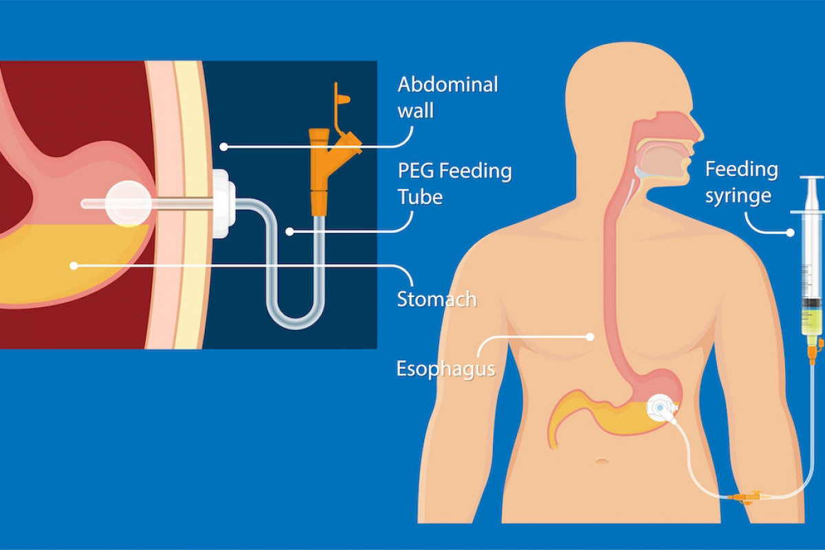 Illustration of PEG feeding tube