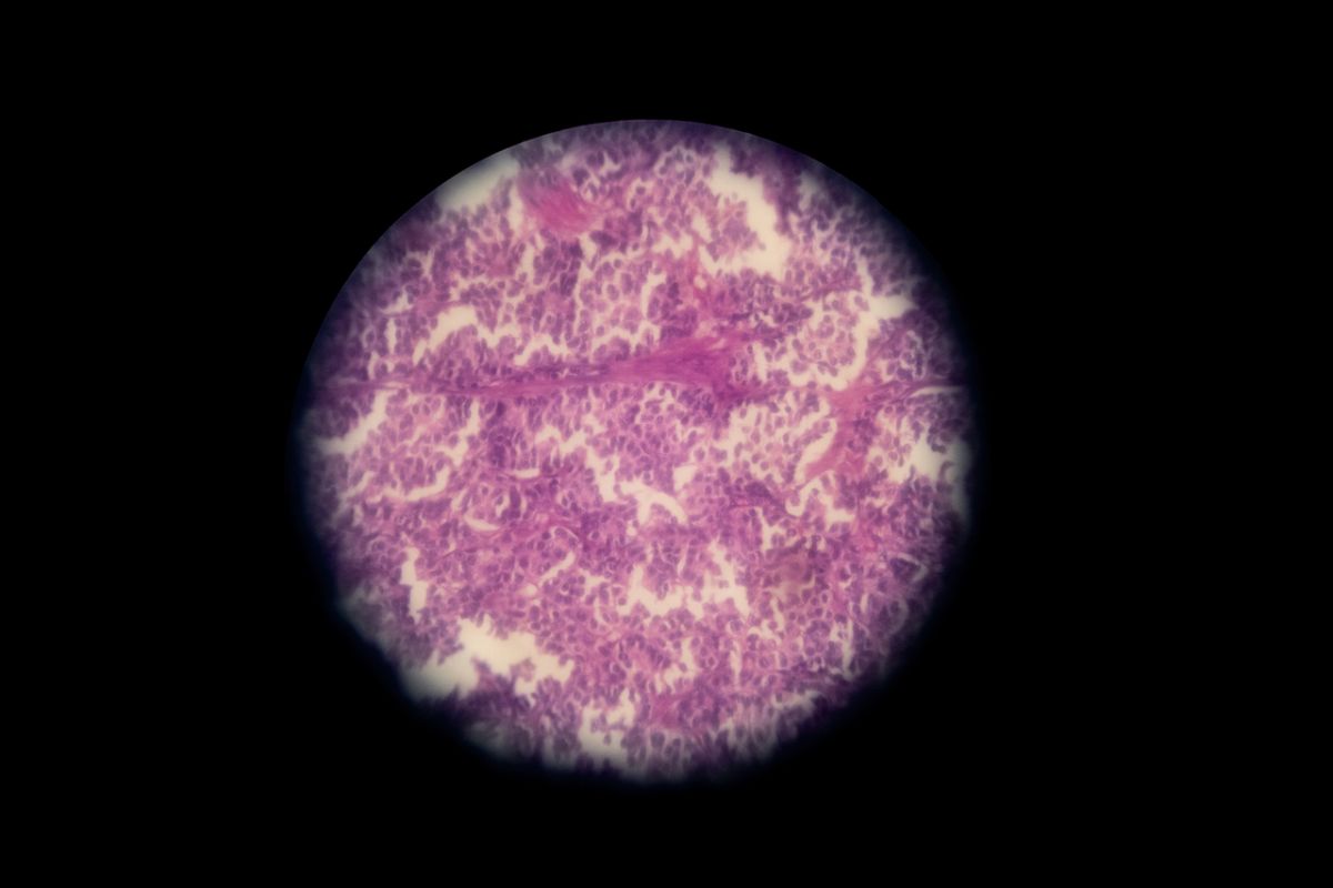 Neuroendocrine carcinoid under microscope