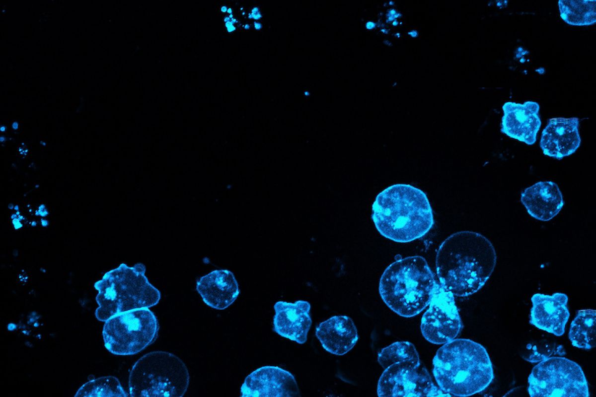 Leukemia cells fluorescing blue over a black backgrounnd
