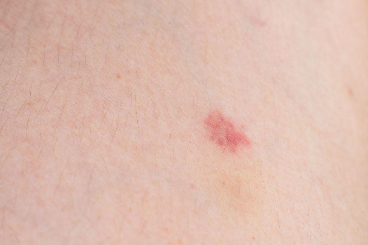 A flat red freckle appears on a section of skin. 