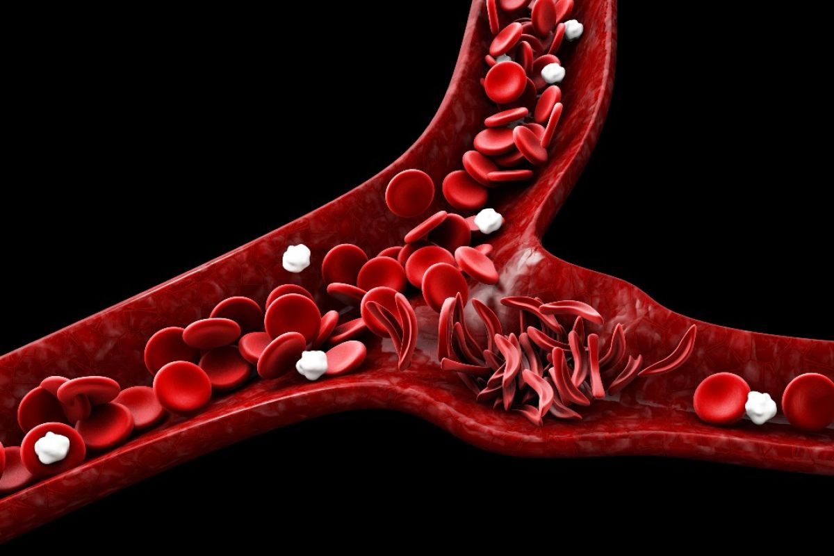 Healthy red blood cells and those deformed by sickle cell disease are shown in a blood vessel. 