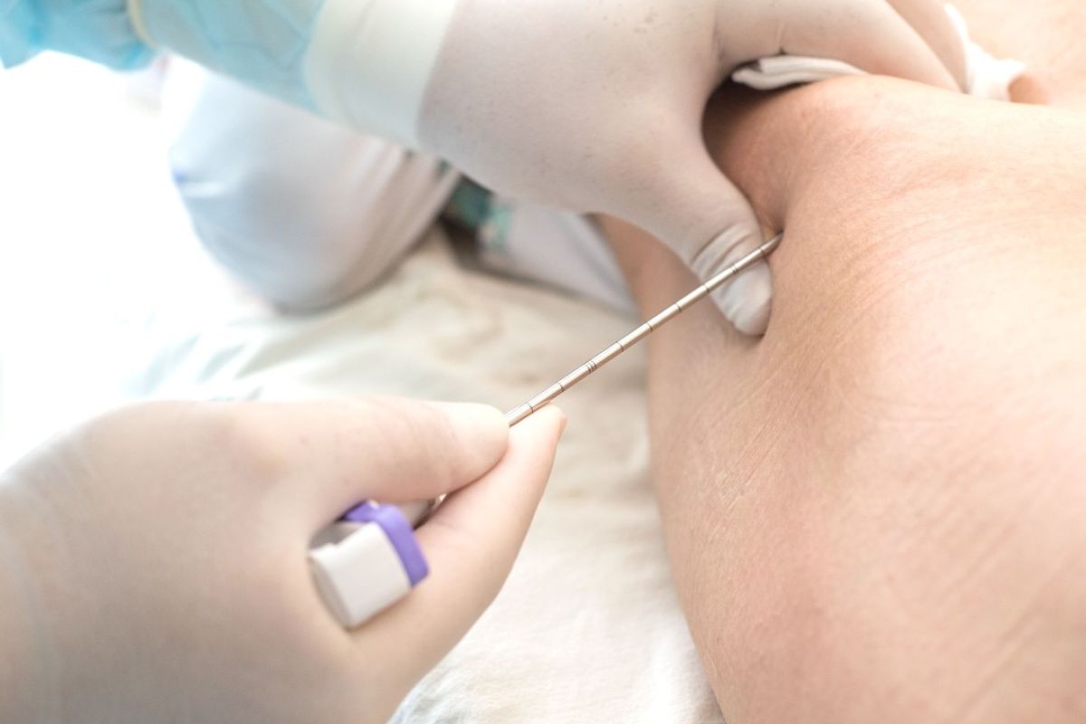 A doctor inserts a long needle into a patient's leg to perform a biopsy. 