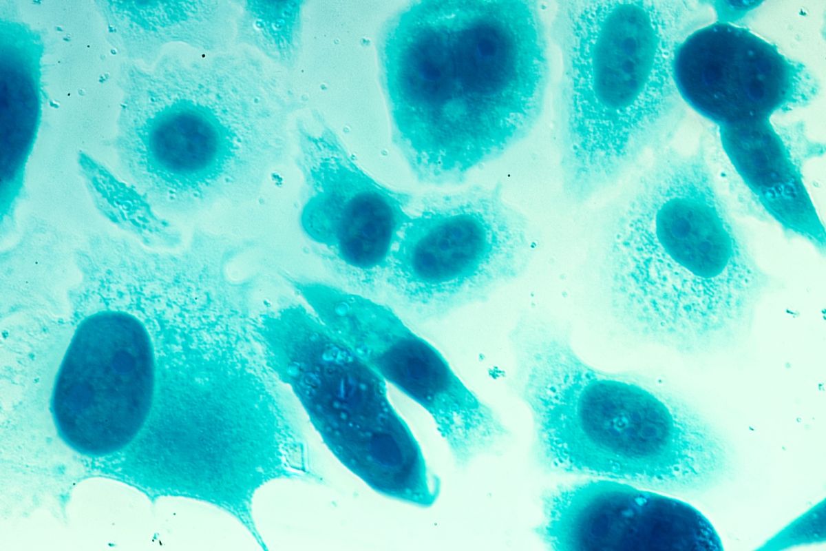 Prostate cancer cells