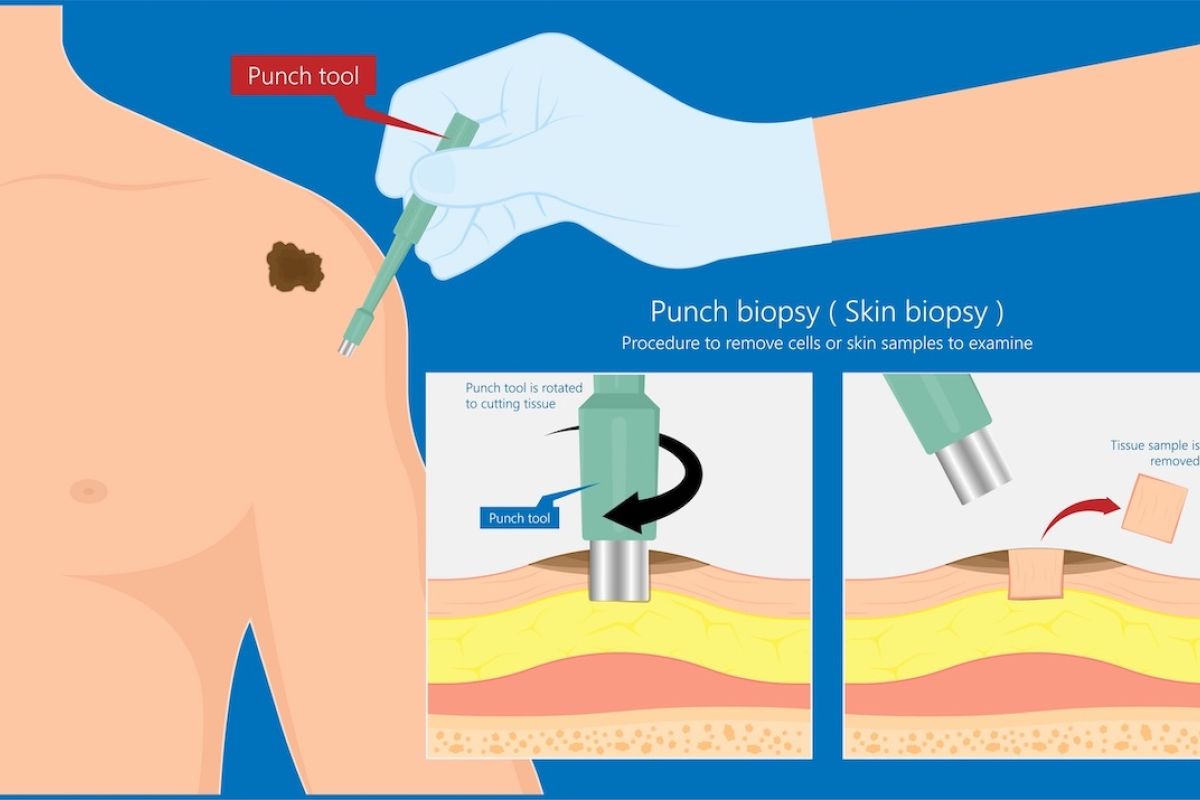 medical illustration of punch biopsy