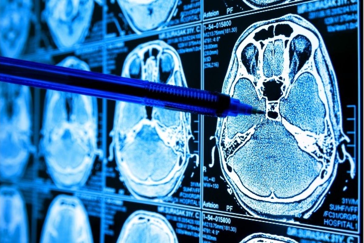 Medical imaging showing brain tumor