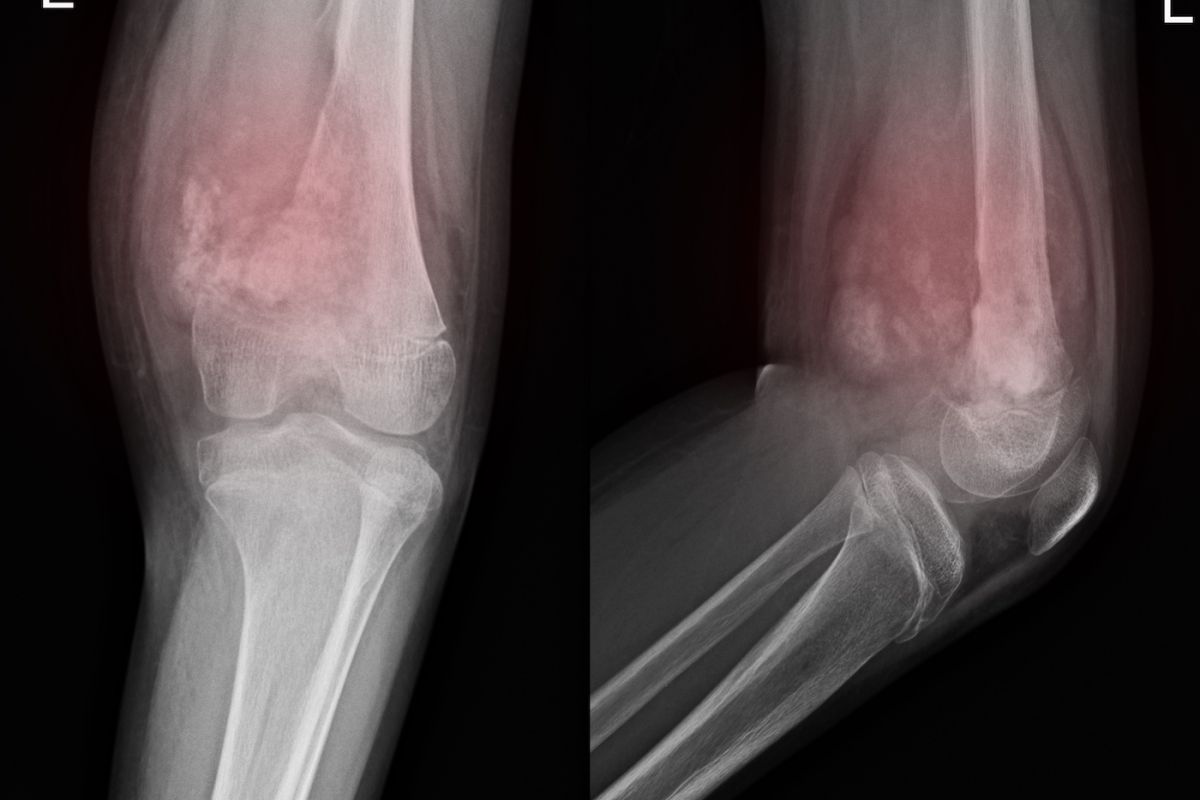 X-ray of a knee showing a soft tissue mass sarcoma - stock