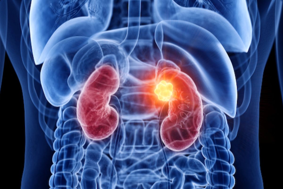 Illustration showing human torso with tumor in one kidney