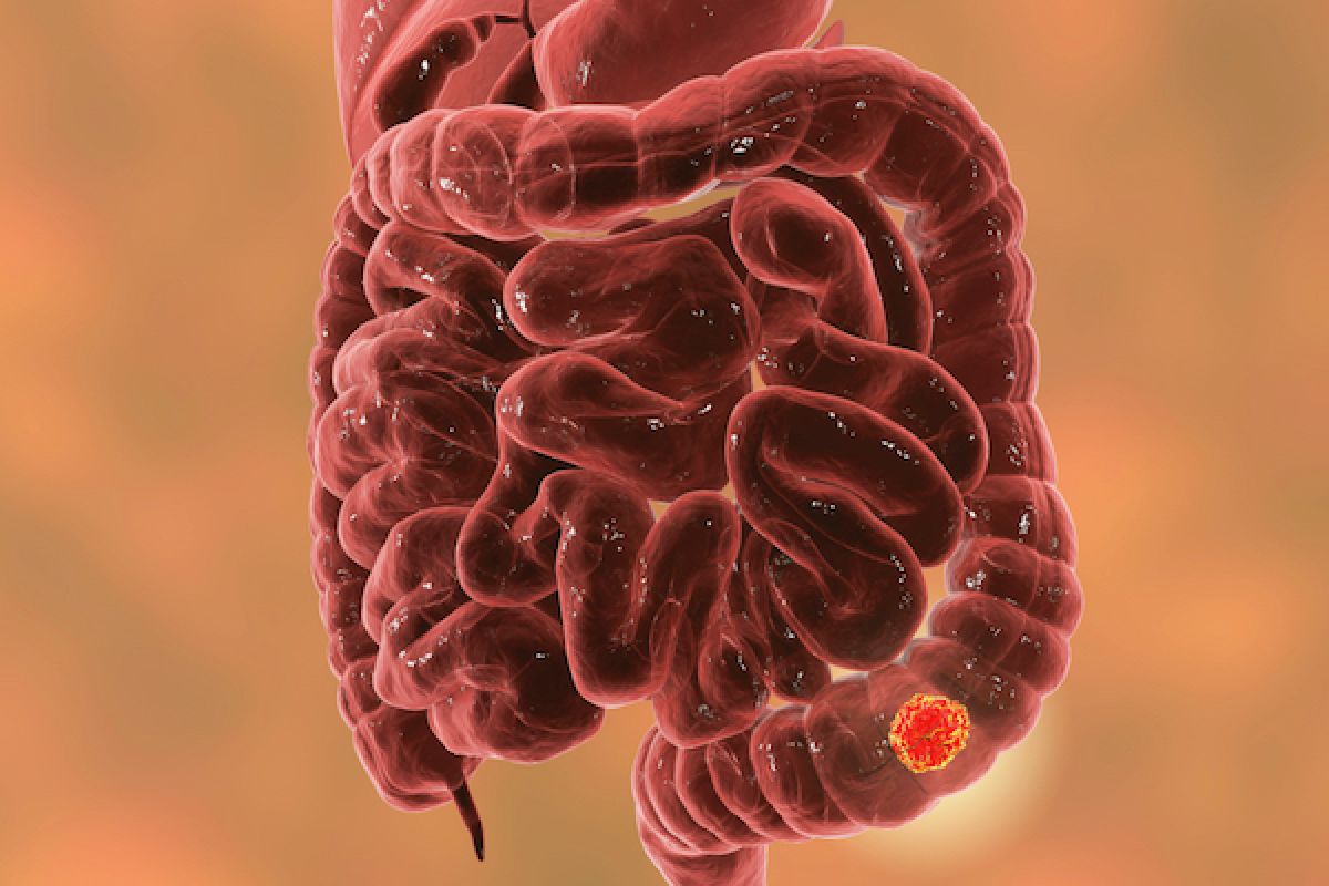 Brown and tan medical illustration showing a tumor in the large intestine