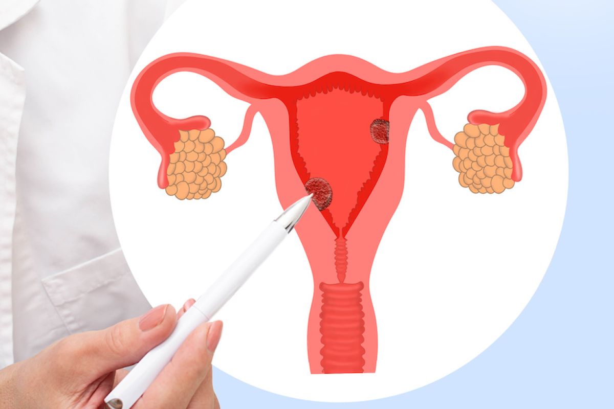 Diagram of uterus with polyps