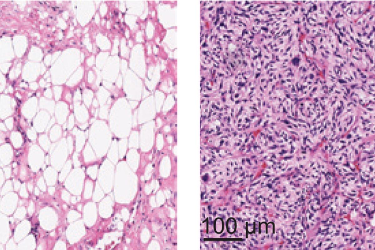 Microscope slides of liposarcoma 