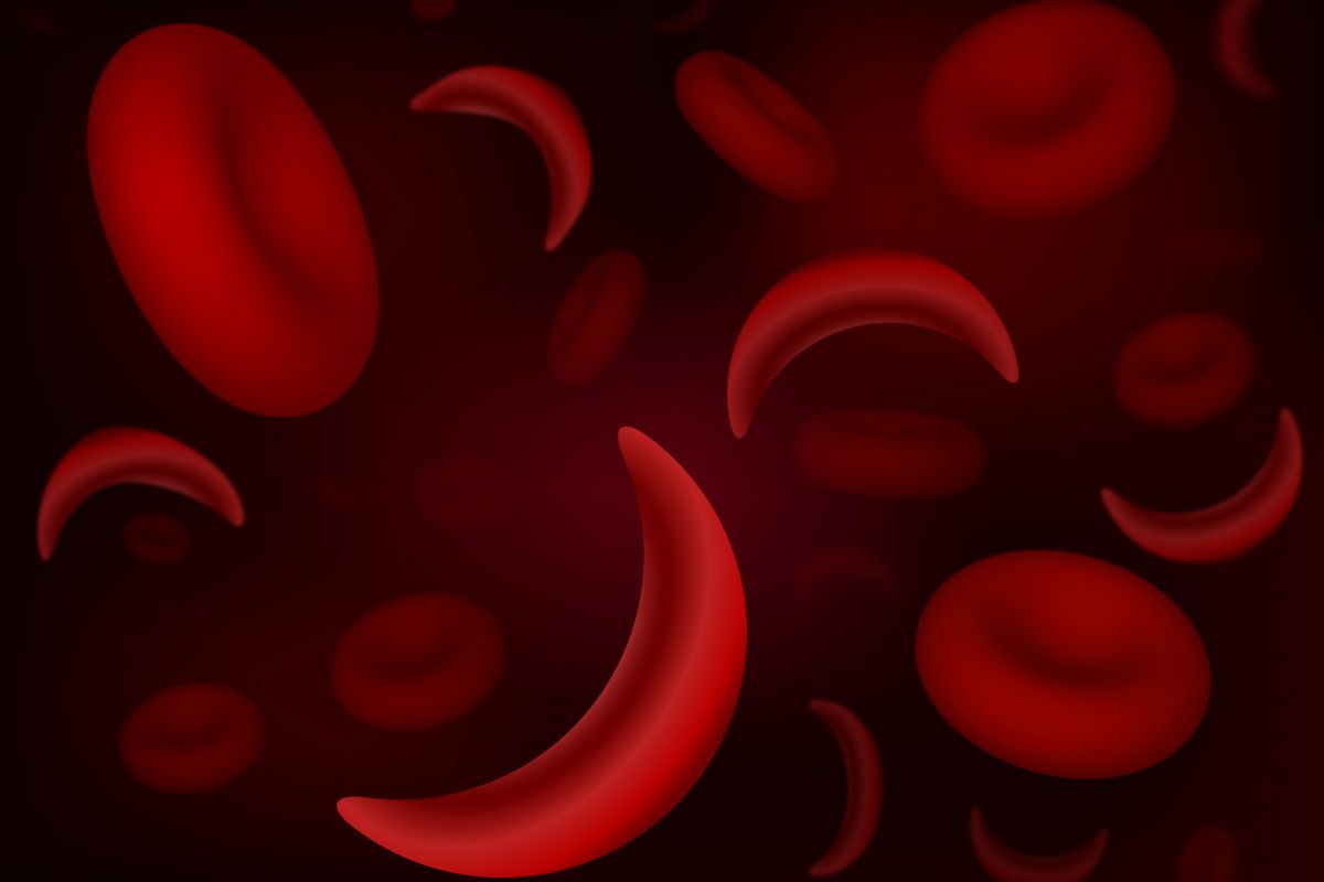 What Is Sickle Cell Disease? Roswell Park Comprehensive Cancer Center