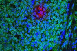 Treatment-Resistant Breast Cancer Cells - 2016 NCI Cancer Close Up project. Source: National Cancer Institute \ Dana-Farber Harvard Cancer Center at Massachusetts General Hospital.