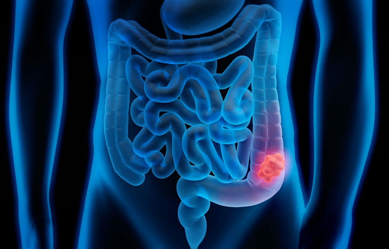 Colon cancer tumor 