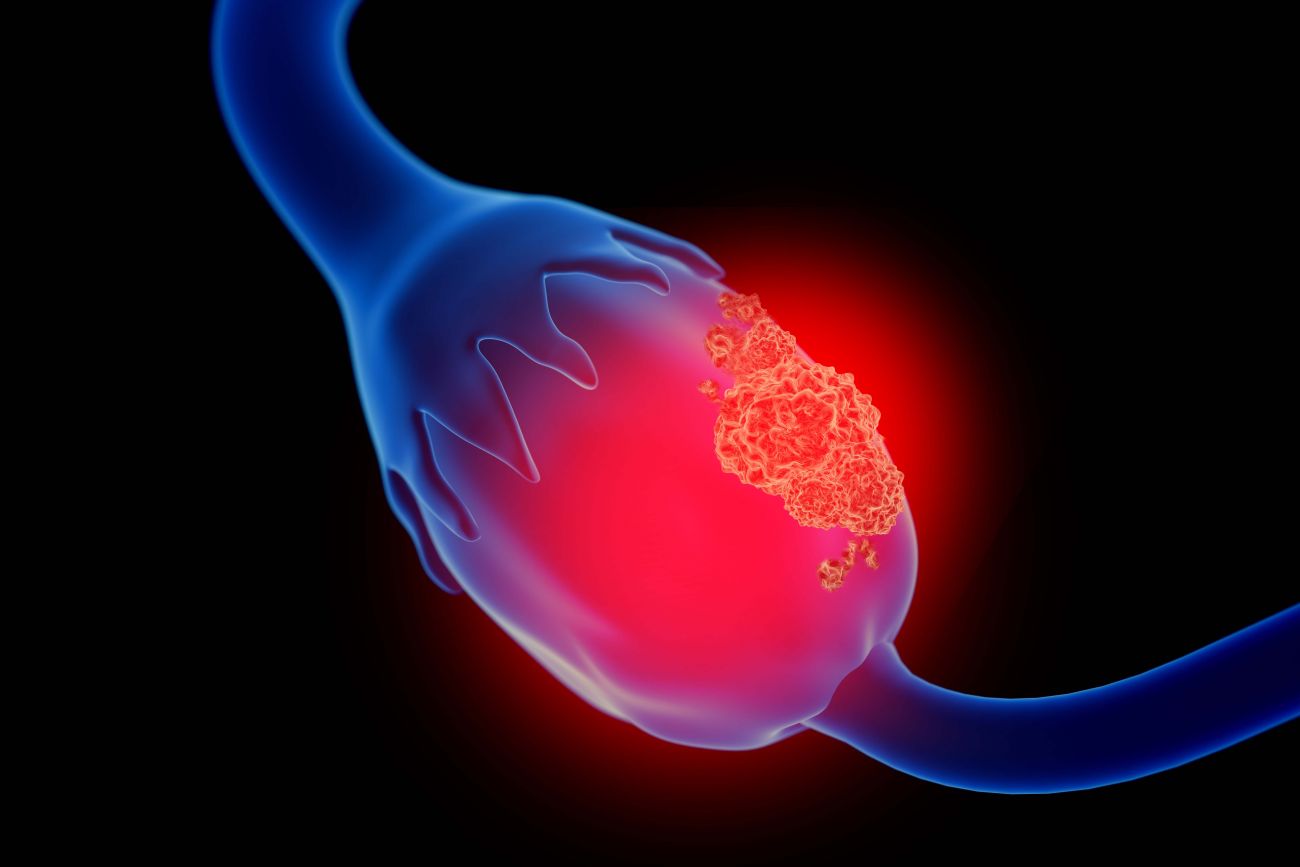 Understanding your ovarian cancer risk