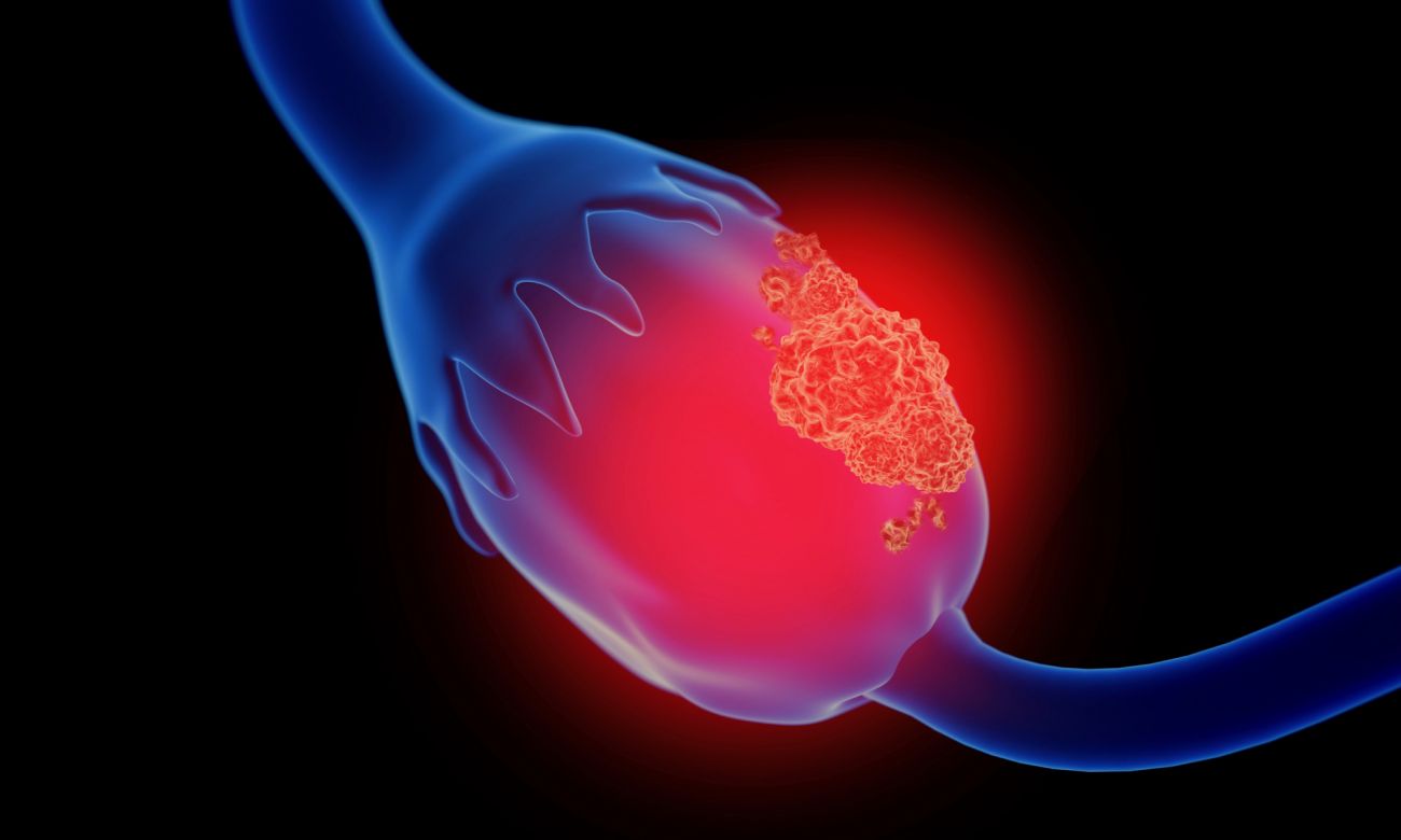 Illustration of an ovarian cancer tumor