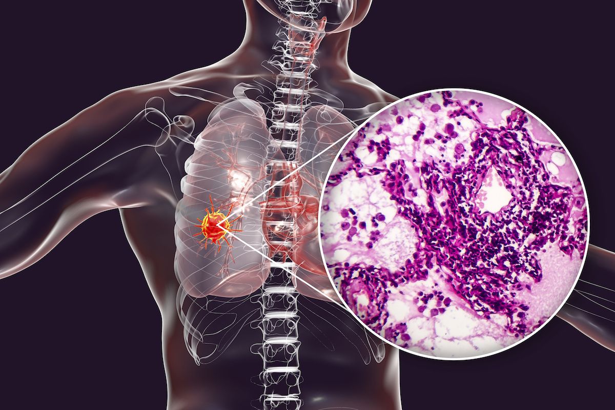 illustration of lung biopsy