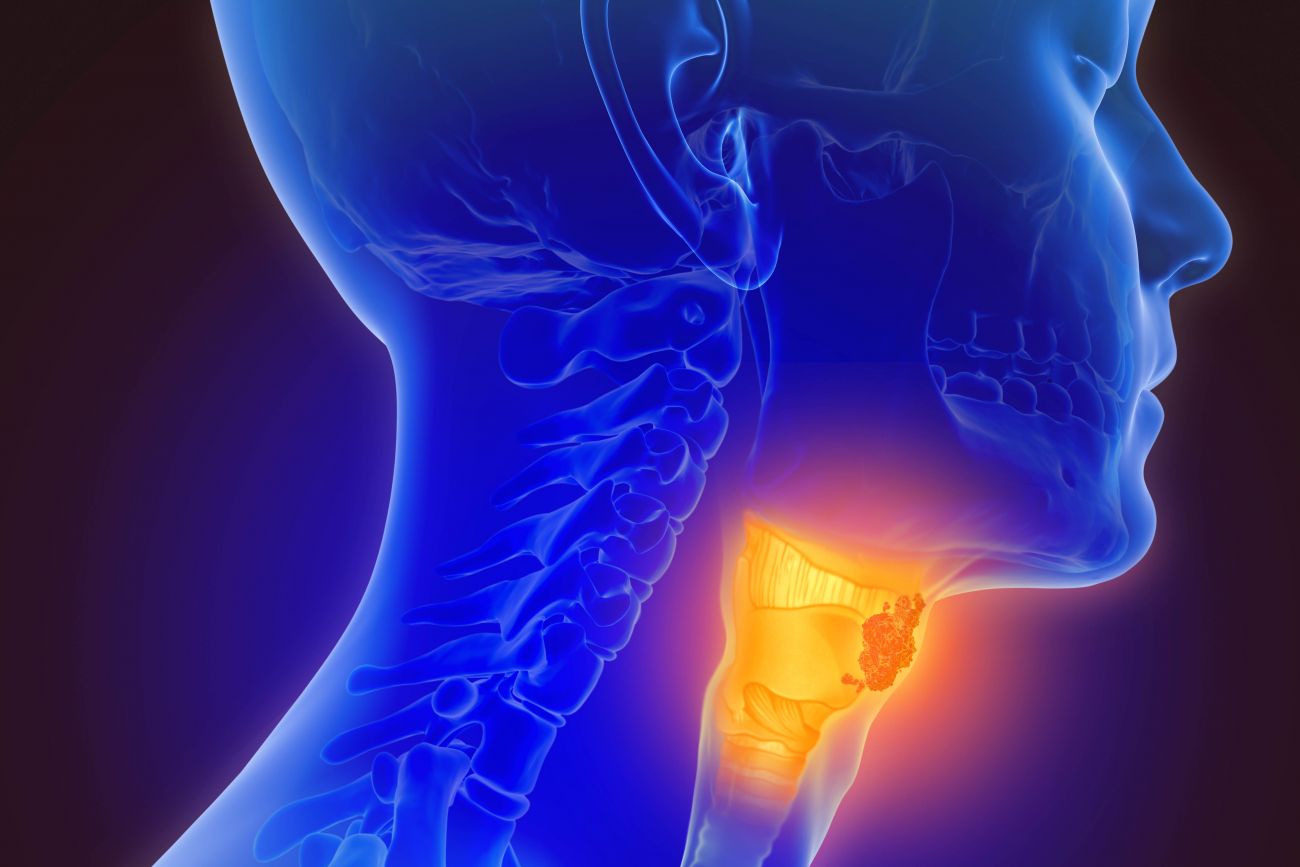 Graphic of tumor in throat