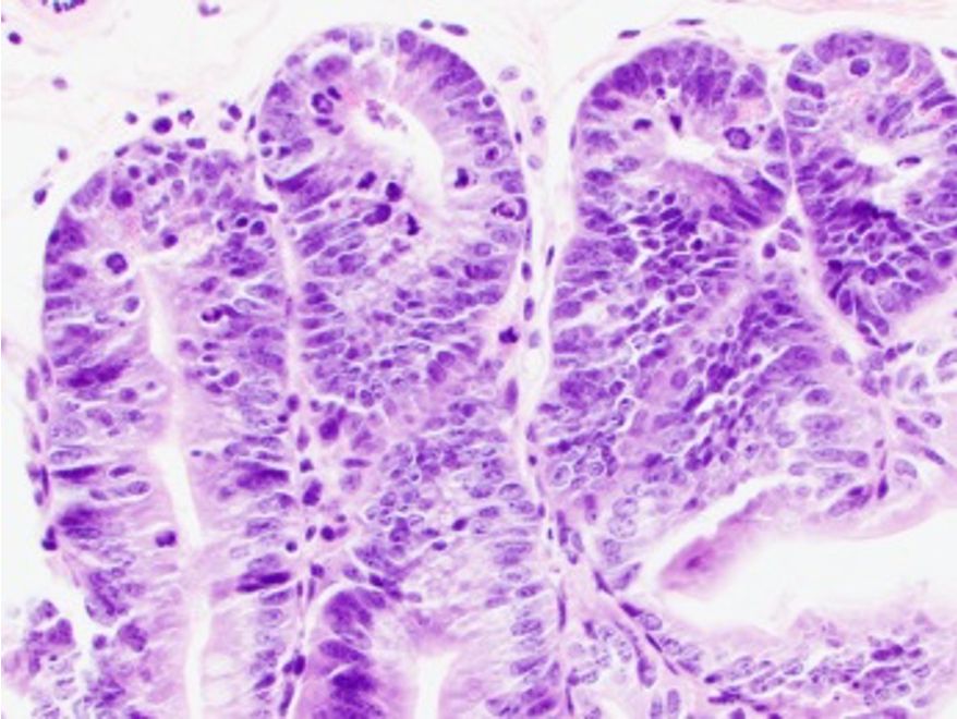 Small intestine cells showing signs of GVHD