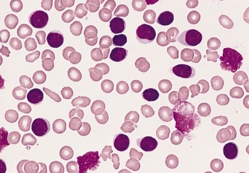 B-Cell Chronic Lymphocytic Leukemia