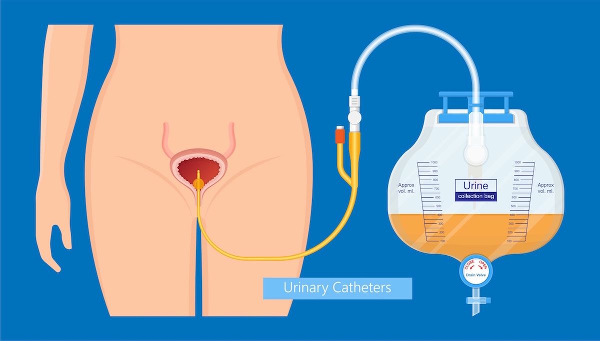 Illustration shows Foley catheter and how it connects to the bladder