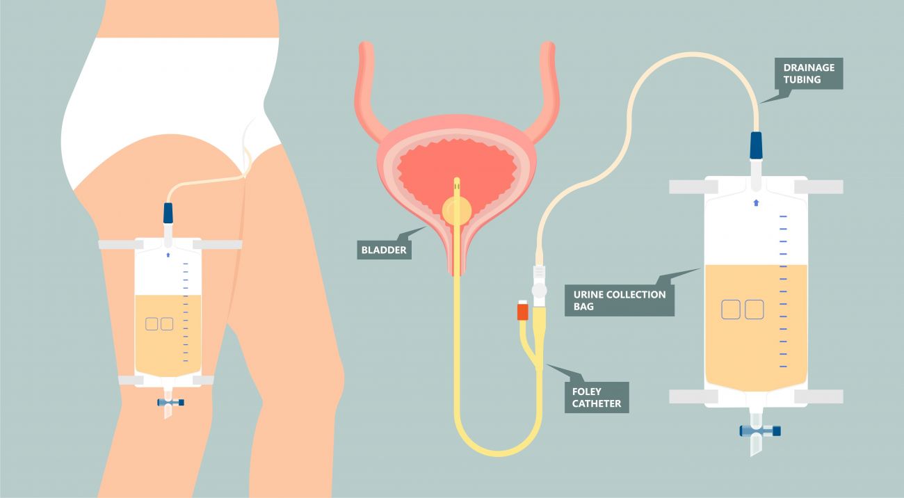 Illustration shows how Foley catheter connects to bladder, and someone wearing a leg bag