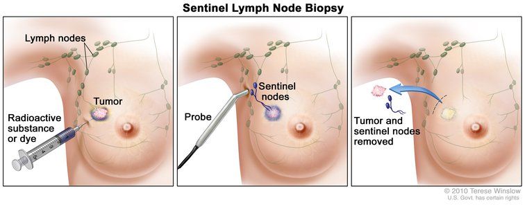 Sentinel lymph node biopsy of the breast