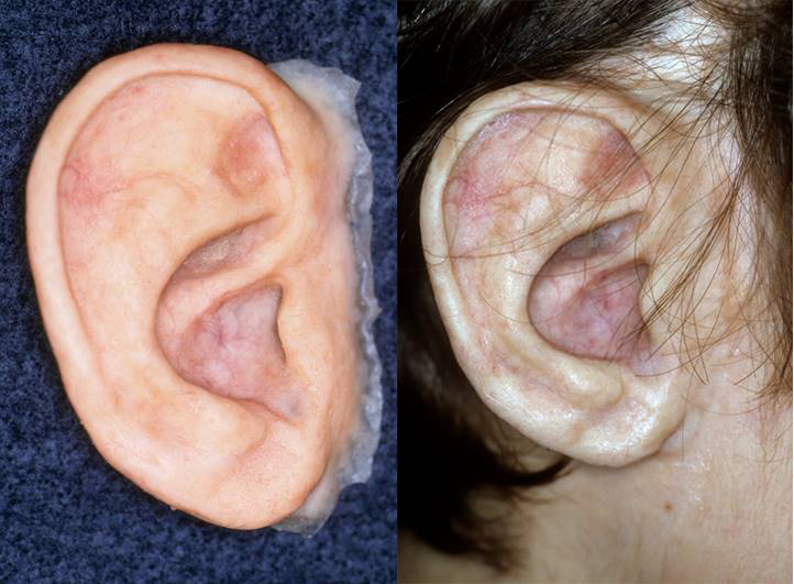 Before and After - Ear Prosthesis