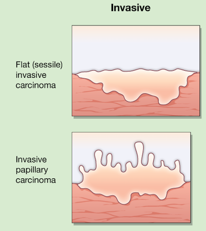 Diagram of differences between invasive tumors