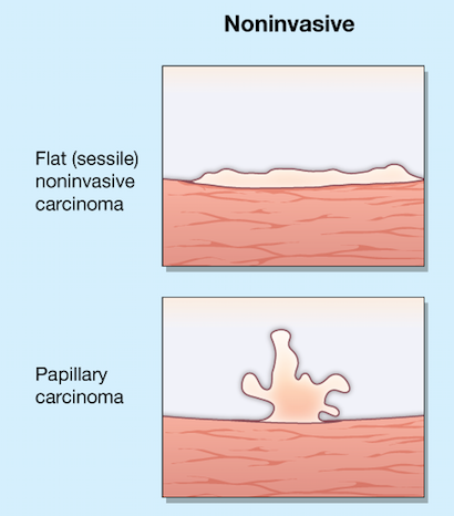 Diagram of differences between noninvasive tumors