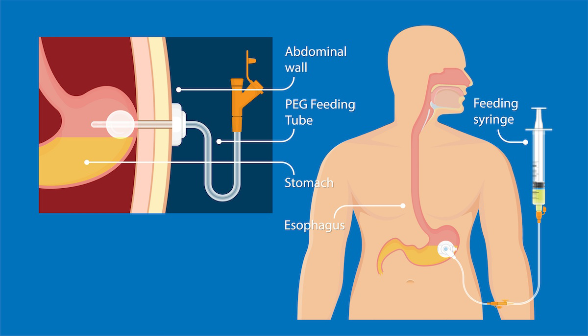 Illustration of PEG feeding tube