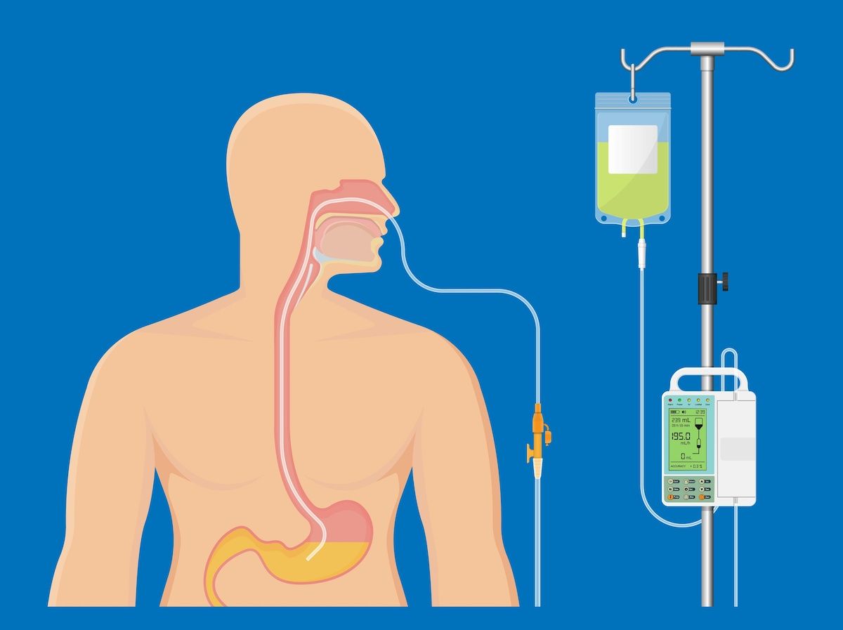 Medical illustration of nasogastric feeding tube