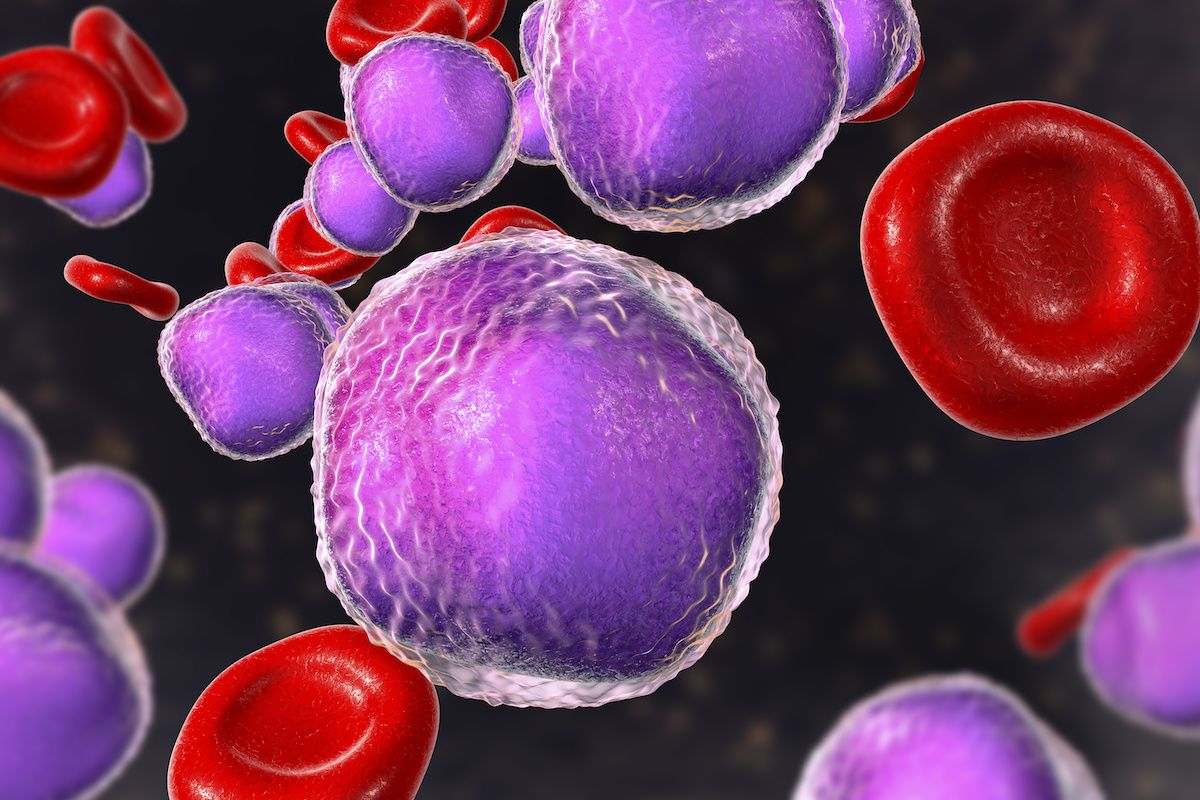 Medical illustration of acute lymphoblastic leukemia cells