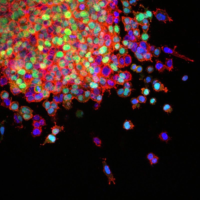 Close up of metastatic lung cancer cells