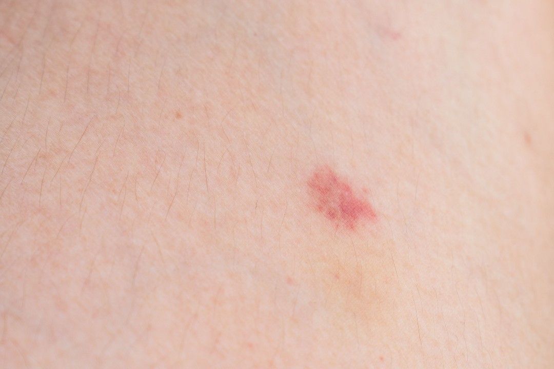 Is petechiae a symptom of leukemia?