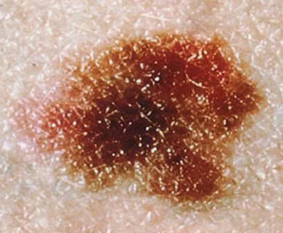 Signs of Skin Cancer - Rough 