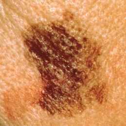 Signs of Skin Cancer - Diameter